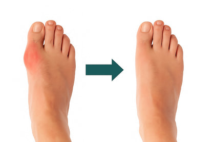 Corrector Ortopédico Premium para Juanetes